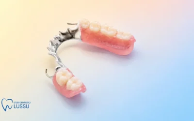 Protesi scheletrata: cos’è, come funziona e quando è la soluzione giusta per i denti mancanti.