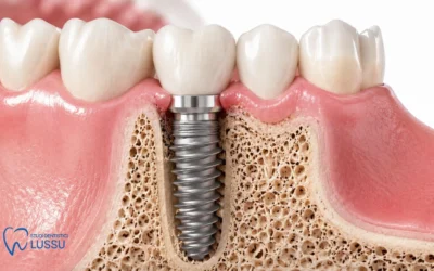 Rigetto Impianto dentale: cause, sintomi e come prevenirlo
